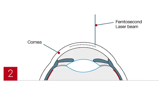 FEMTO-LASIK