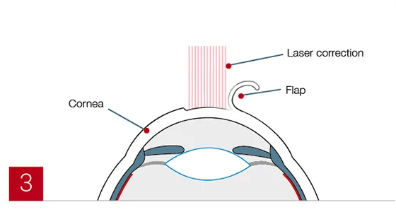 FEMTO-LASIK